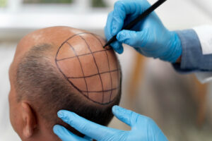 hair restoration marketing